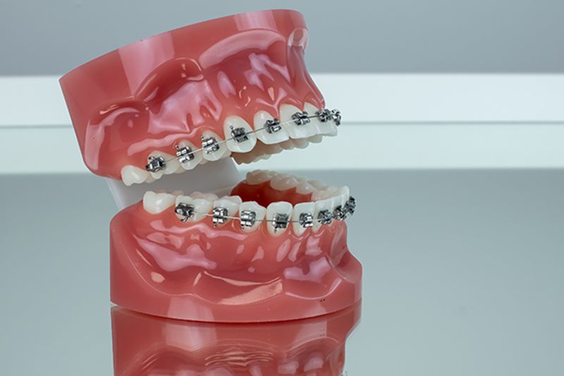 Metal Braces